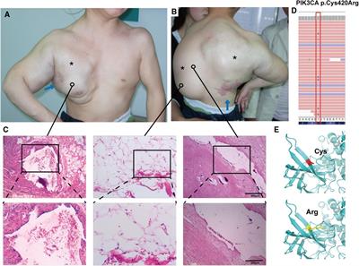 Combined surgery and sclerotherapy for 13 years: a case report of a patient with CLOVES